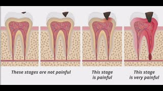 Stages of Tooth Decay Introduction [upl. by Annuaerb262]