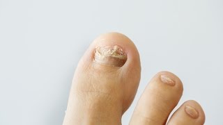 How to prevent and treat nail fungus [upl. by Schlosser]