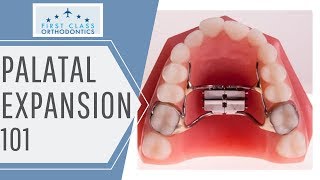 FIRST CLASS ORTHODONTICS  Palatal Expander 101 [upl. by Kravits]