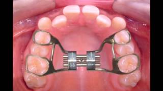 Rapid Palatal Expander [upl. by Nahtaoj]