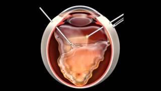 Retinal Detachment  Signs Symptoms and Treatment [upl. by Hannis]