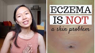 what causes eczema [upl. by Longley]