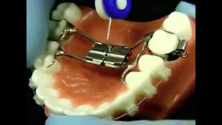 Palatal Expander with Hildebrand Orthodontics [upl. by Cochard]