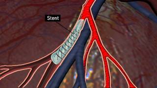 Carotid Stenting and Endarterectomy [upl. by Onairda]