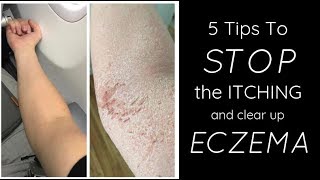 HEALING ECZEMA  5 Things I Do Each Day To STOP THE ITCH [upl. by Charlena]