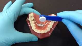 Palatal Expander Activation [upl. by Lindsey]