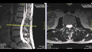 Normal Lumbar Spine MRI Explained  Dr Jeffrey P Johnson  HD [upl. by Lenrow816]