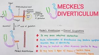 Meckels Diverticulum With Clinical Correlations [upl. by Narcissus]