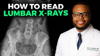 How to Read a Lumbar XRay [upl. by Asir]