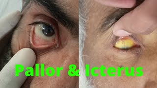 PALLOR and ICTERUS in EYE  ANEMIA and JAUNDICE in eye examination [upl. by Jasmin]