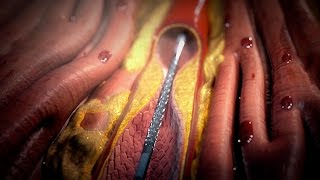 Stent Procedure [upl. by Ydarg297]