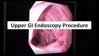 Endoscopia digestiva alta sem cortes [upl. by Cal]