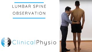 Lumbar Spine Observation  Clinical Physio [upl. by Elohc777]