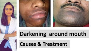 Darkening around mouth  causes  treatment  Dermatologist  Dr Aanchal Panth [upl. by Aeikan419]