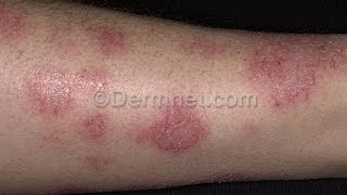 Varicose Eczema  7 Facts About Varicose Eczema You Must Know [upl. by Rubinstein255]