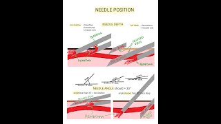 Venipuncture  How to Position a Needle [upl. by Anitsirhc]