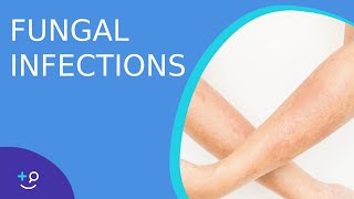 Fungal Infections  Causes Prevention and Cure [upl. by Araek]