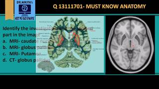 MRI Brain anatomy  Basal ganglia [upl. by Ndnarb]