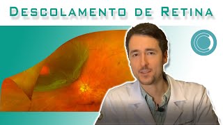 Recuperação da visão após cirurgia para descolamento de retina [upl. by Sirrap]