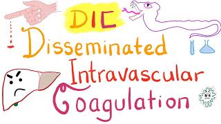 Disseminated Intravascular Coagulation DIC [upl. by Okim]