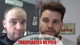 LA VERDAD SOBRE LOS TRASPLANTES DE PELO [upl. by Ron]